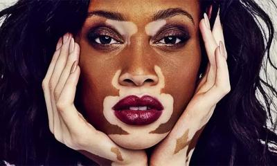 Vitiligo-pic905-895x505-59099~2.jpg